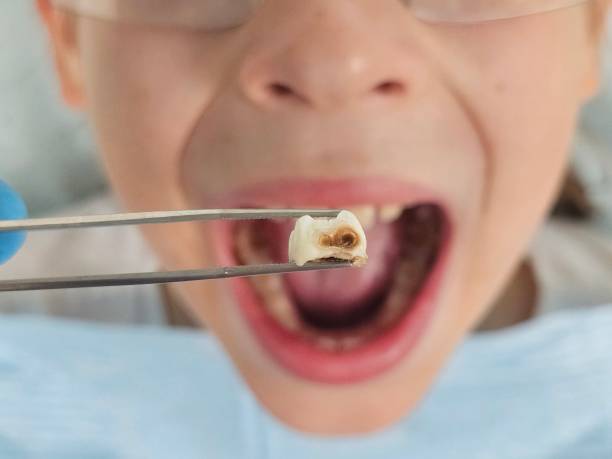 Best Dental Abscess Treatment in Blacksburg, SC