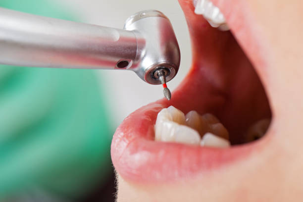 Best Emergency Root Canal Therapy in Blacksburg, SC